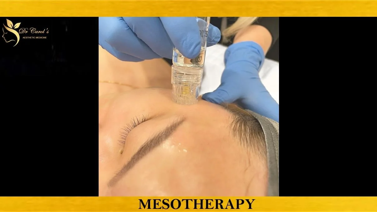 MESOTHERAPY.JPG
