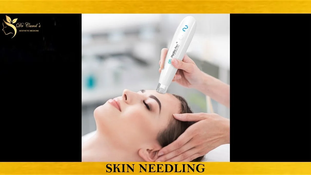 SKIN NEEDLING.JPG