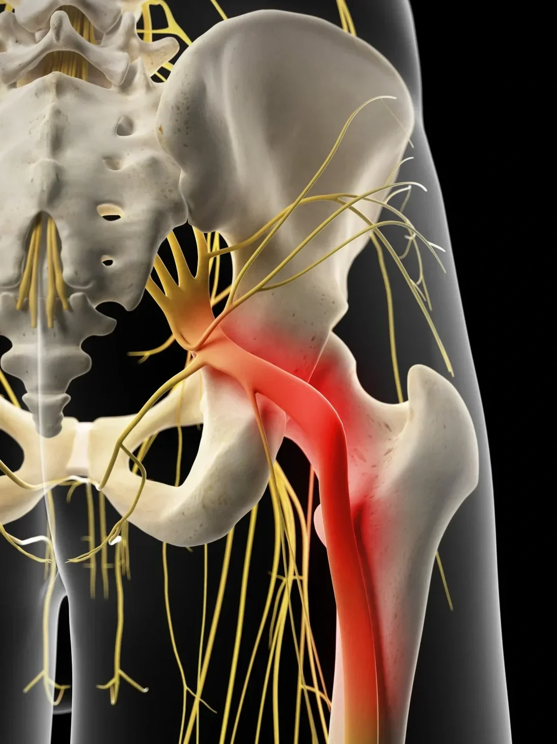 Sciatica Relief in Mineola
