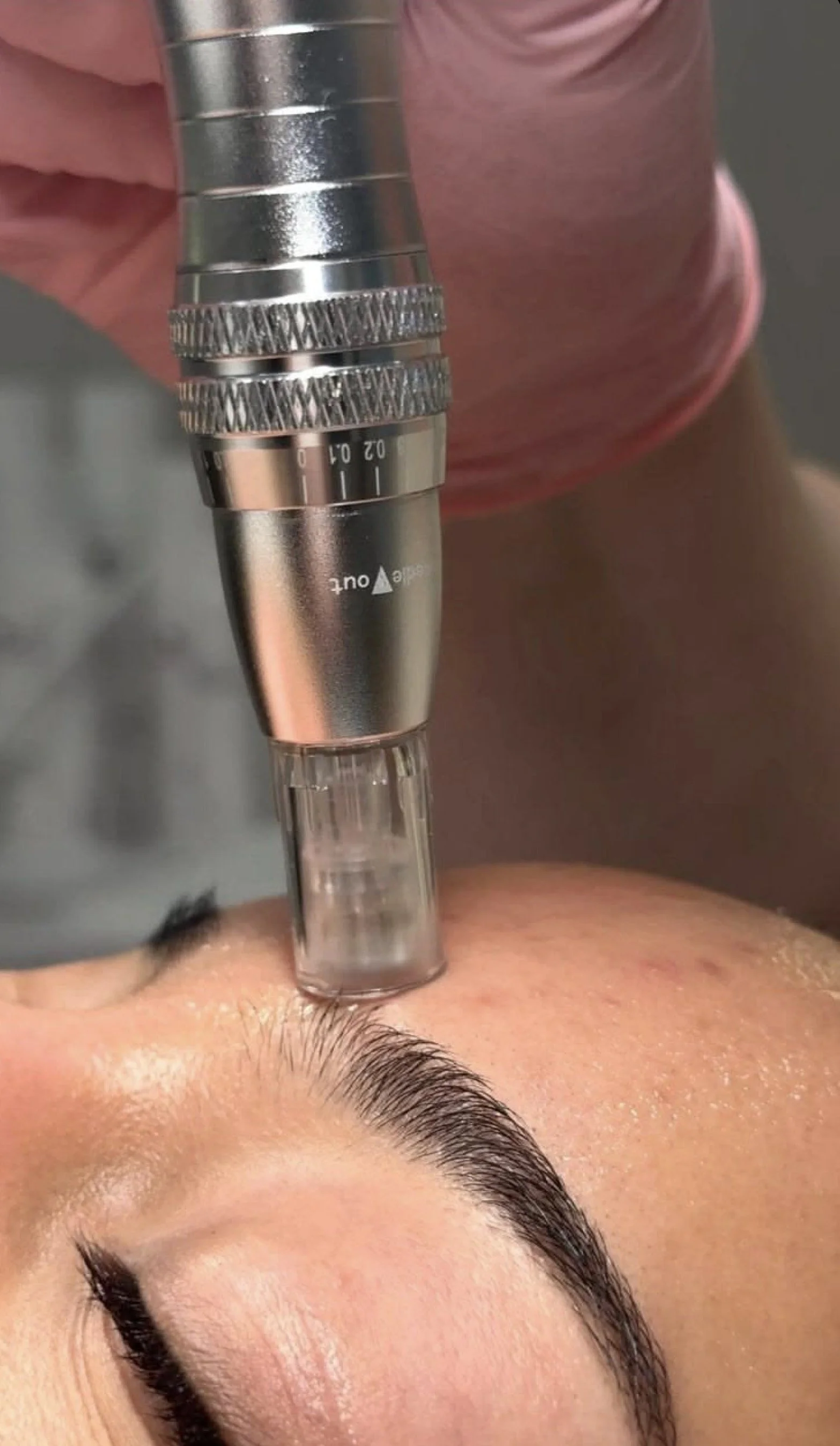Microneedling Facial