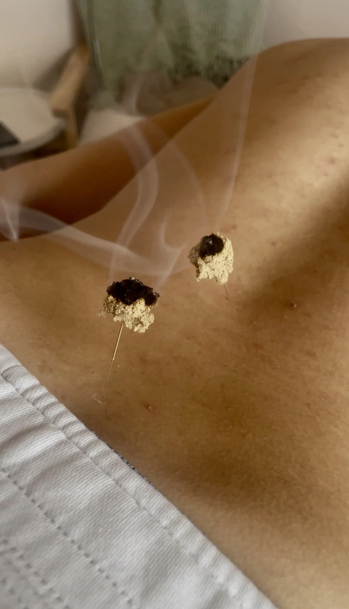 Traditional Acupuncture Follow-up Session