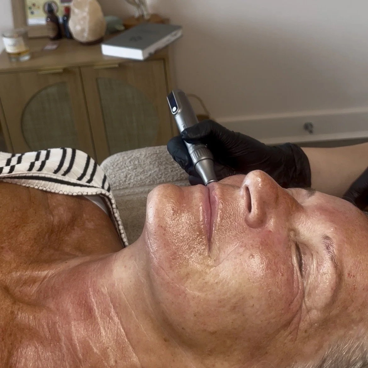 Microneedling + LED Light Therapy