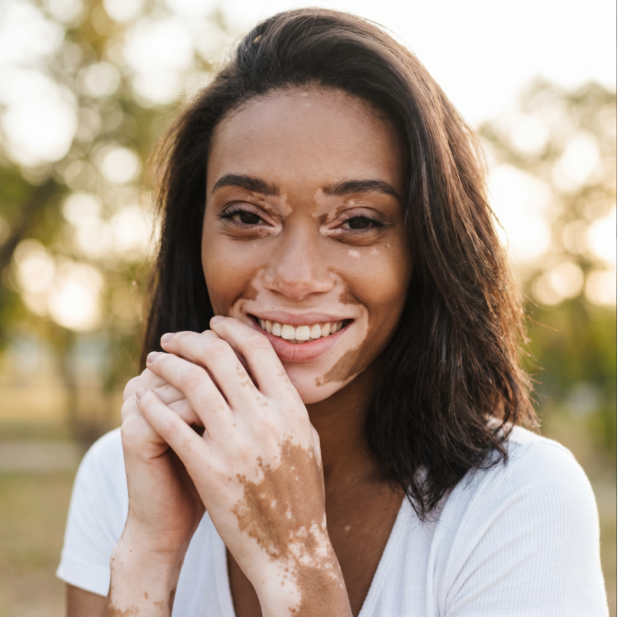 NY Vitiligo