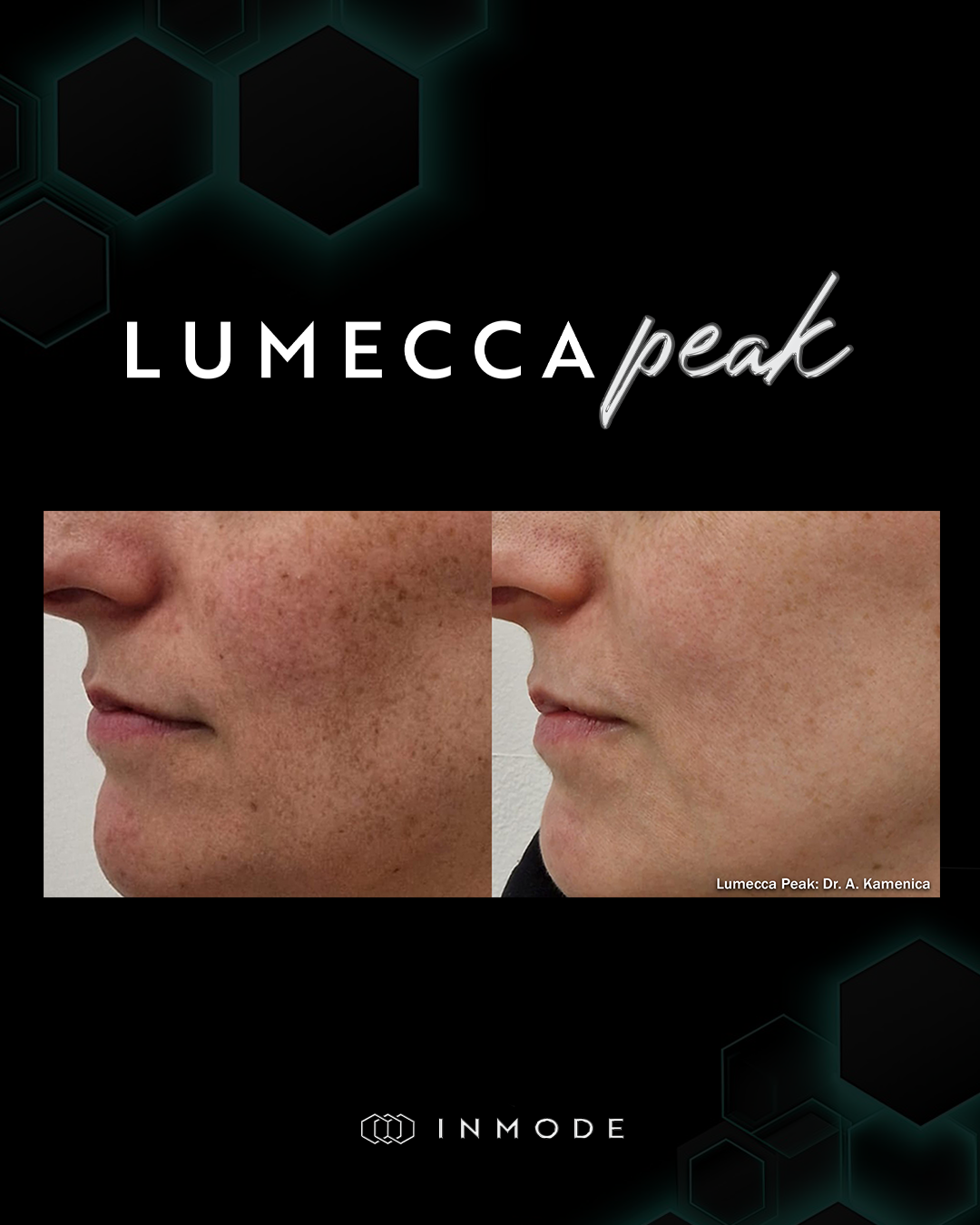 BA_LumeccaPeak_0321_Slide_1.png