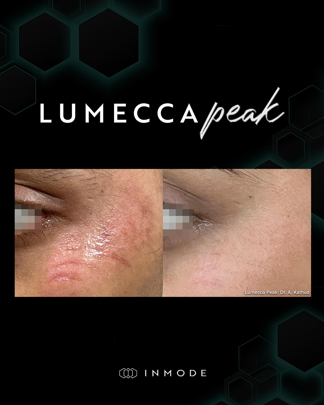 LumeccaPeakBAJune.png