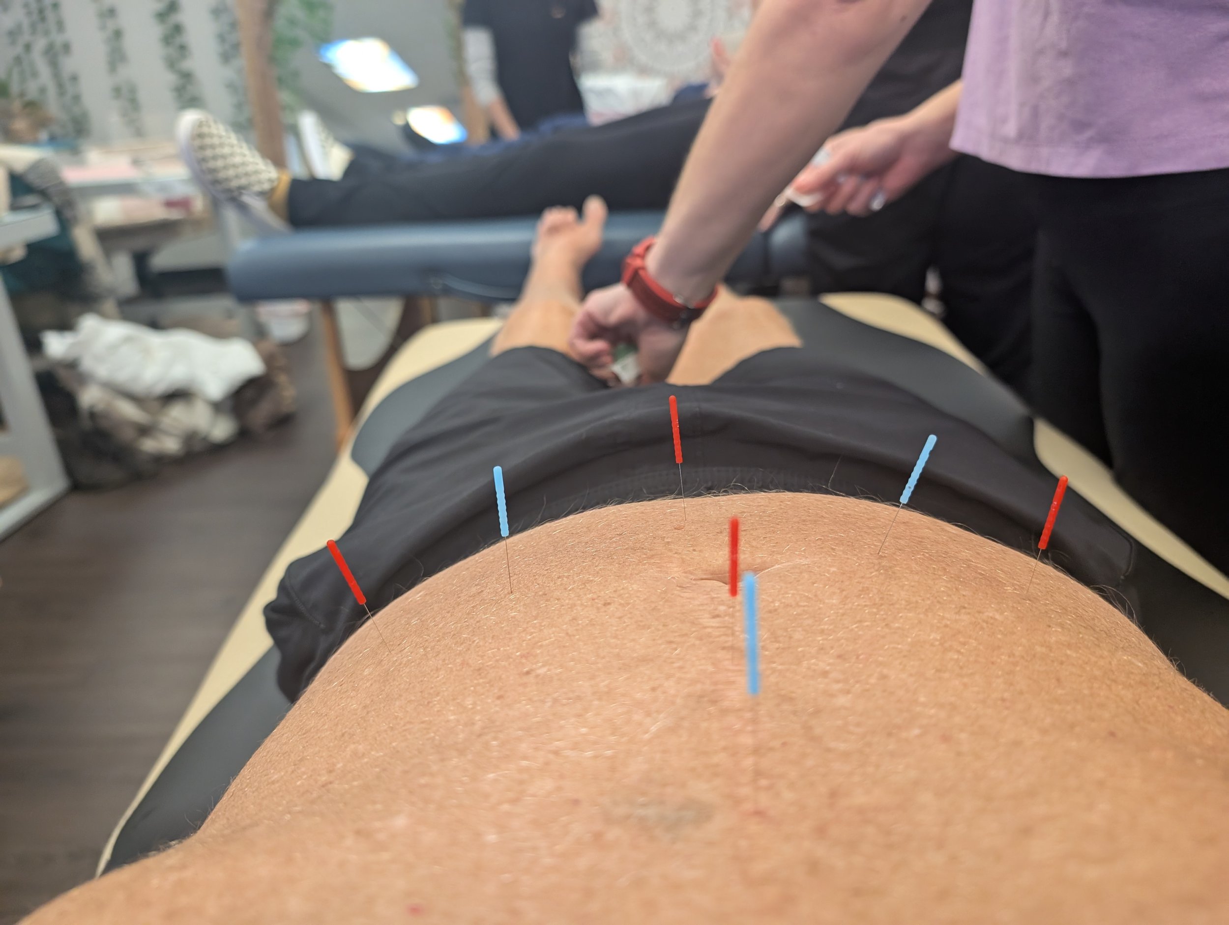 Acuupuncture Recognized by WHO