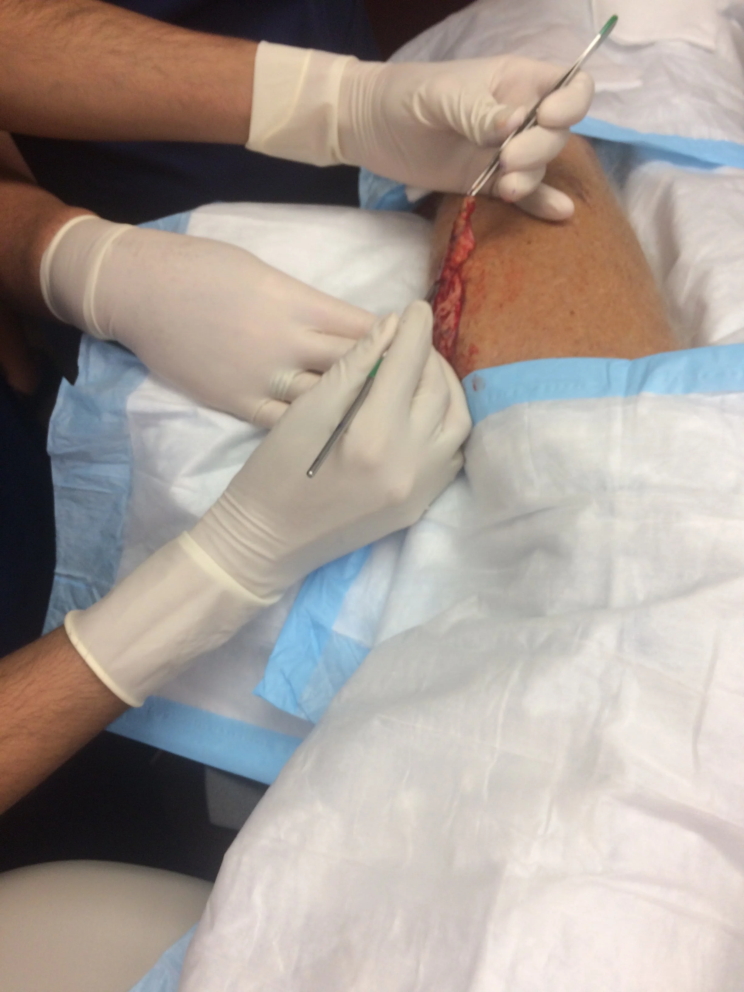Benefits of Acupuncture as part of Melanoma Cancer Management