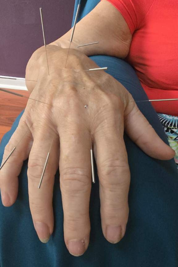 Neuropathy in Cancer: Incidence of Neuropathy by Chemotherapy Agent