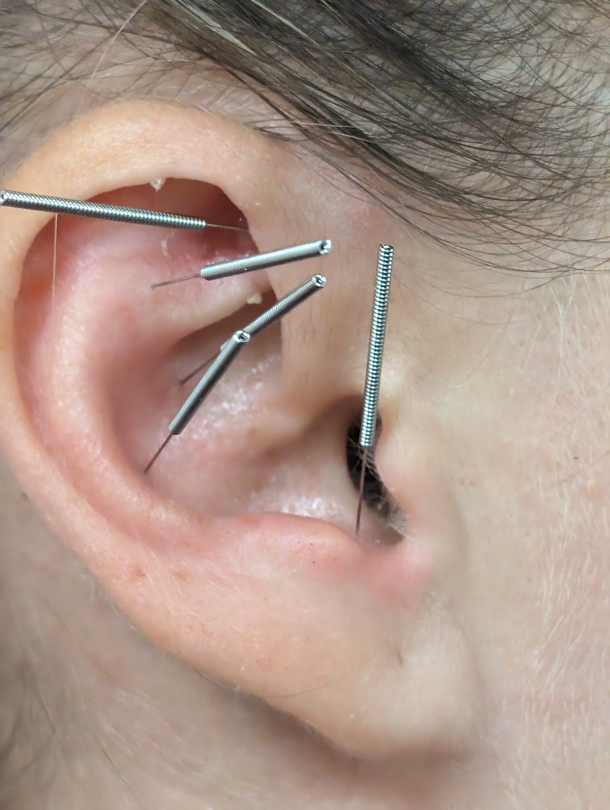 NADA Protocol, Auricular Needles