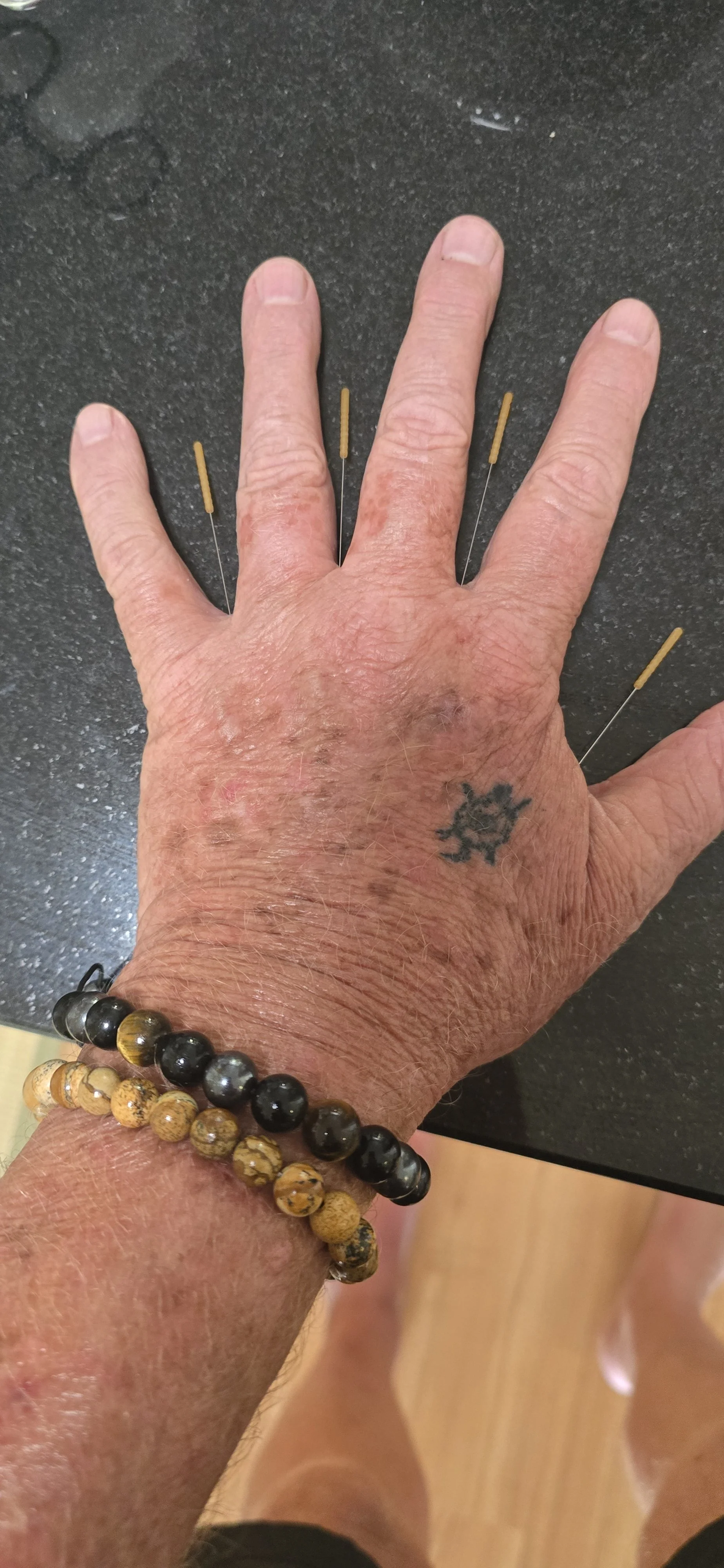 BaXie Needles for Cancer Treatment Induced Hand Neuropathy
