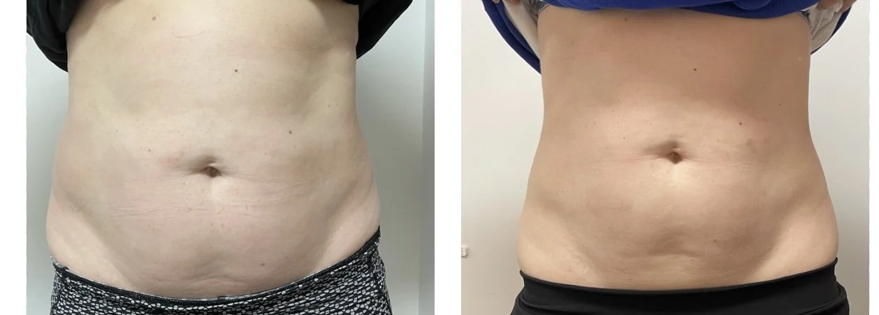 Comparison of a person's midsection before and after weight loss or body transformation, showing a reduction in abdominal fat.