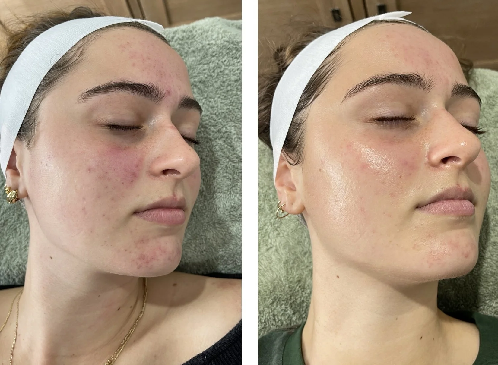 Comparison of a woman's face before and after skin treatment shows reduced redness, acne scars, and improved skin texture on the right side.
