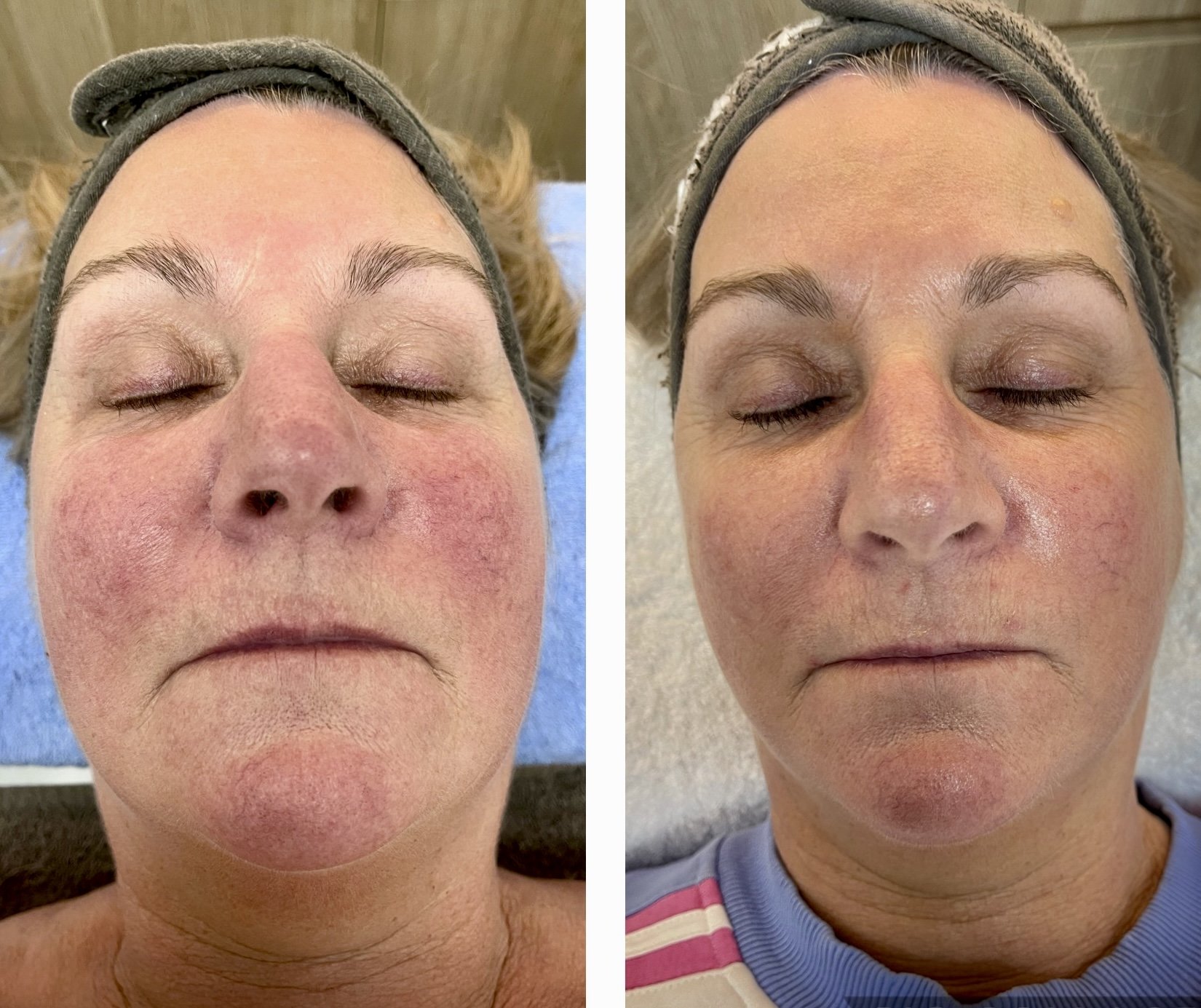 Comparison of a woman's face before (left) and after (right) a skincare treatment, showing improvements in skin redness and texture.