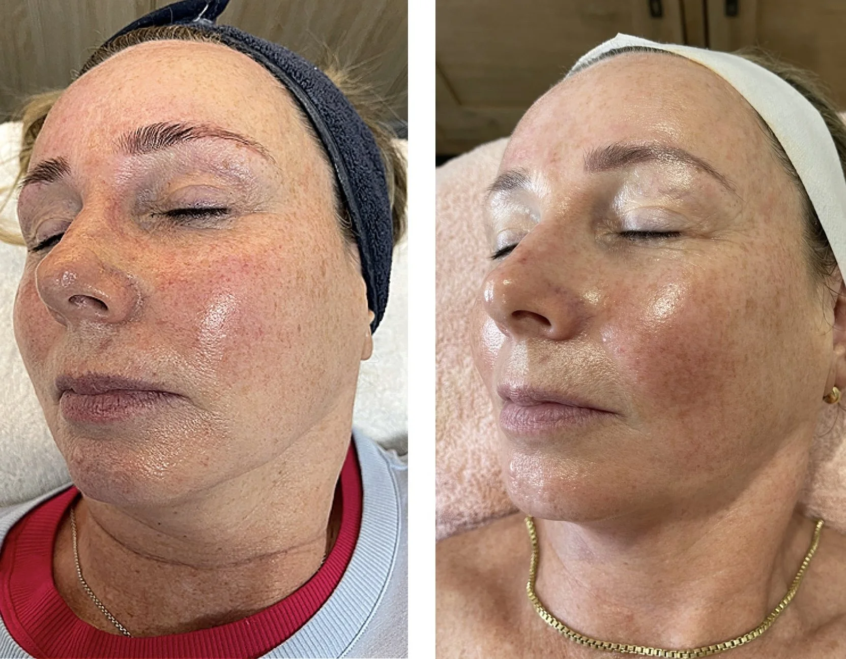 Comparison of a woman's face before and after skincare treatment, showing improved skin texture, brightness, and reduced redness.