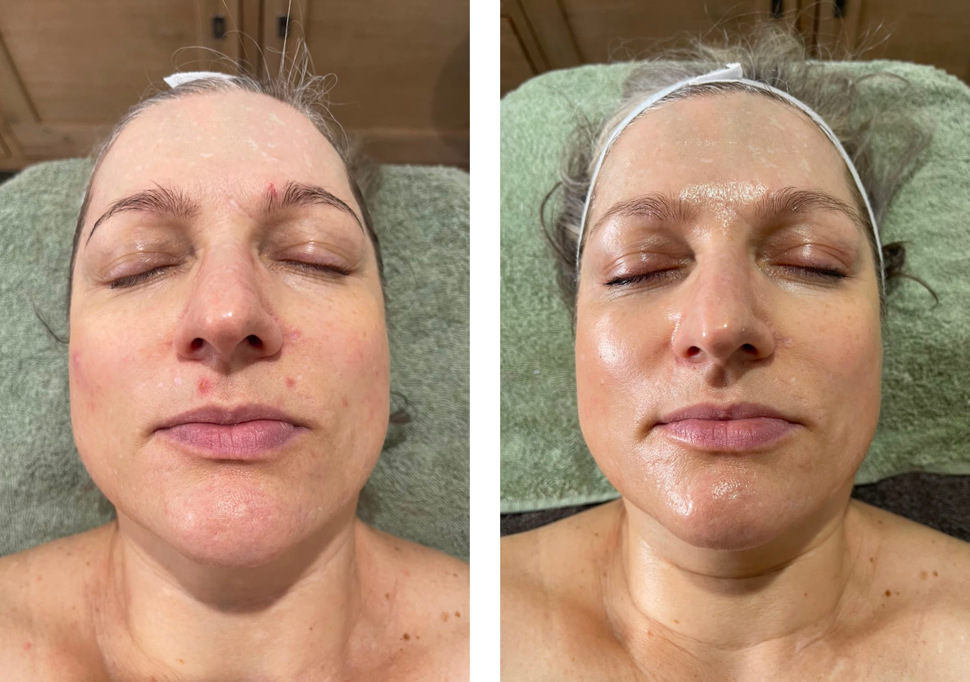 Side-by-side comparison of a woman's face before and after a skincare treatment, showing improvements in skin texture and complexion.