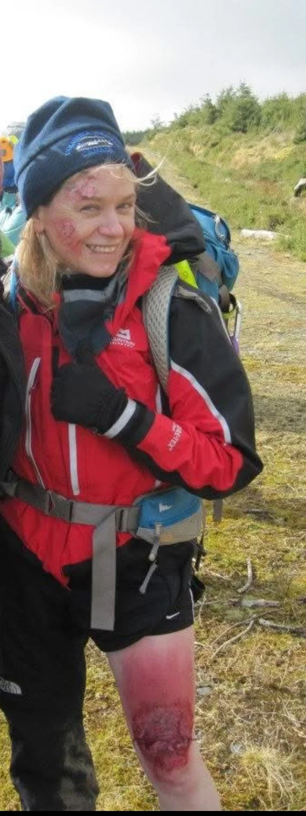 A woman with a scraped and injured leg smiling outdoors in hiking gear, wearing a red jacket, black shorts, and a blue beanie, with a backpack on her back.
