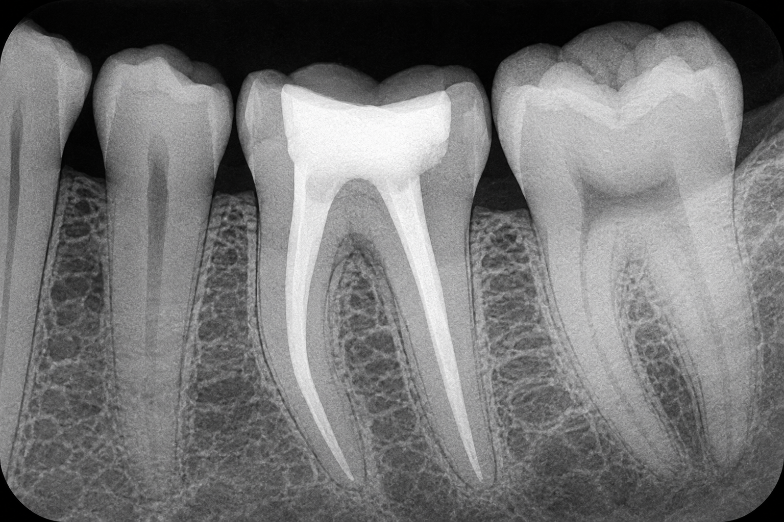 Black and white dental X-ray image showing a molar tooth with a root canal treatment and visible filling material.
