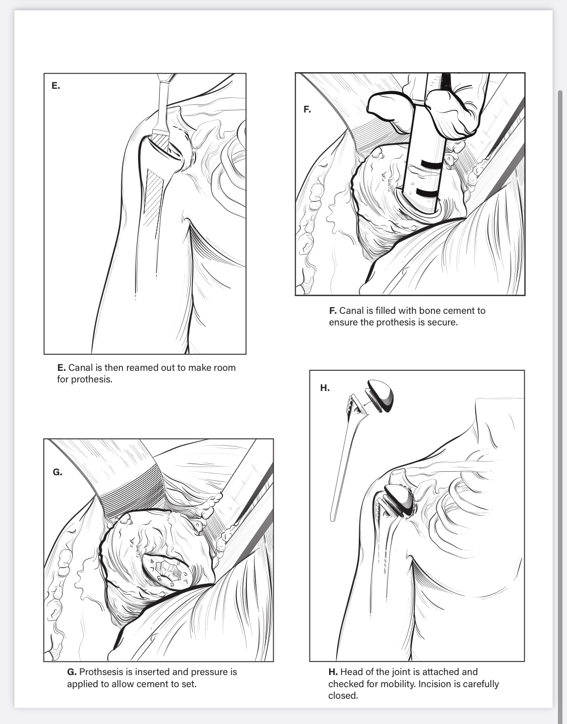 Total Shoulder Arthroplasty - Adobe Illustrator - 2021