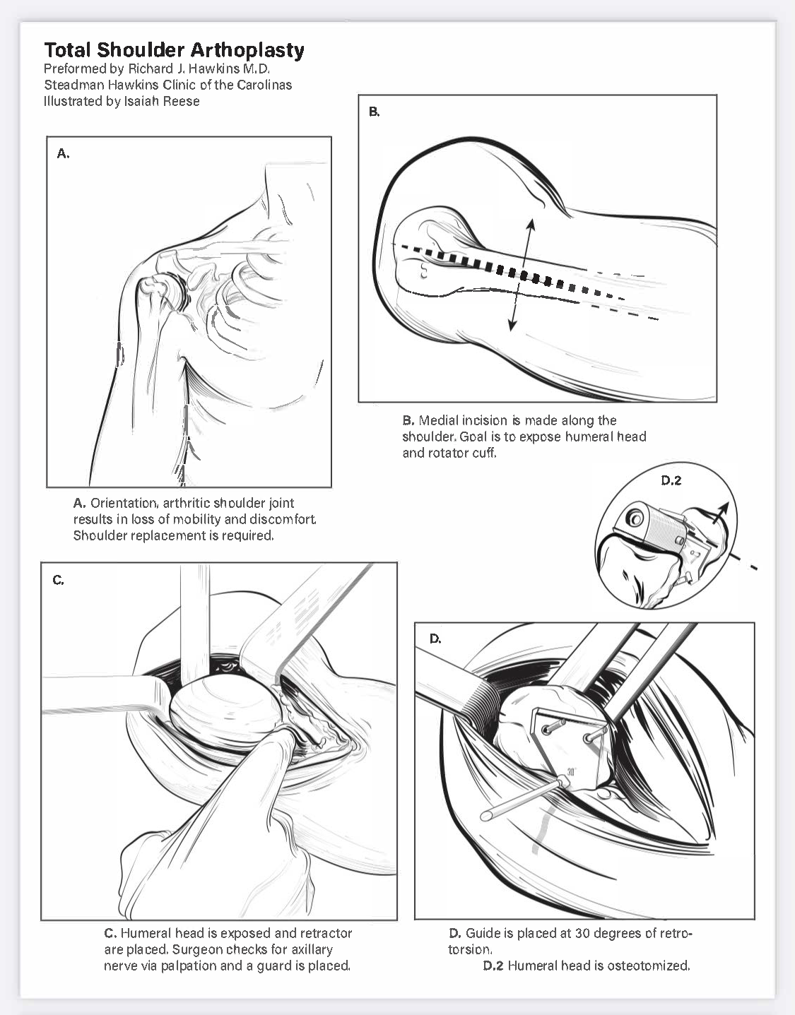 Total Shoulder Arthroplasty - Adobe Illustrator - 2021