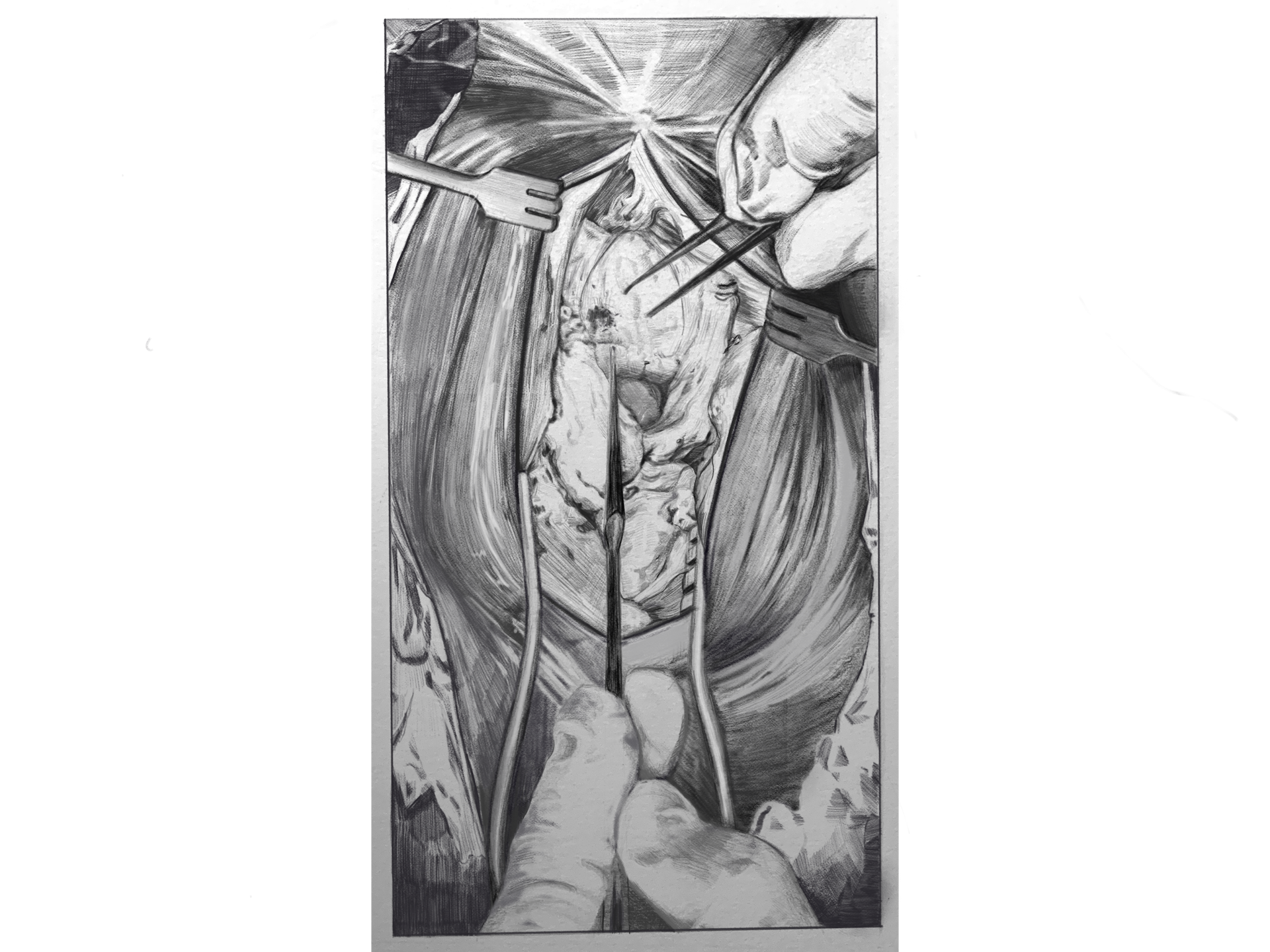 Removal of Patella Lesion - Graphite - 2021