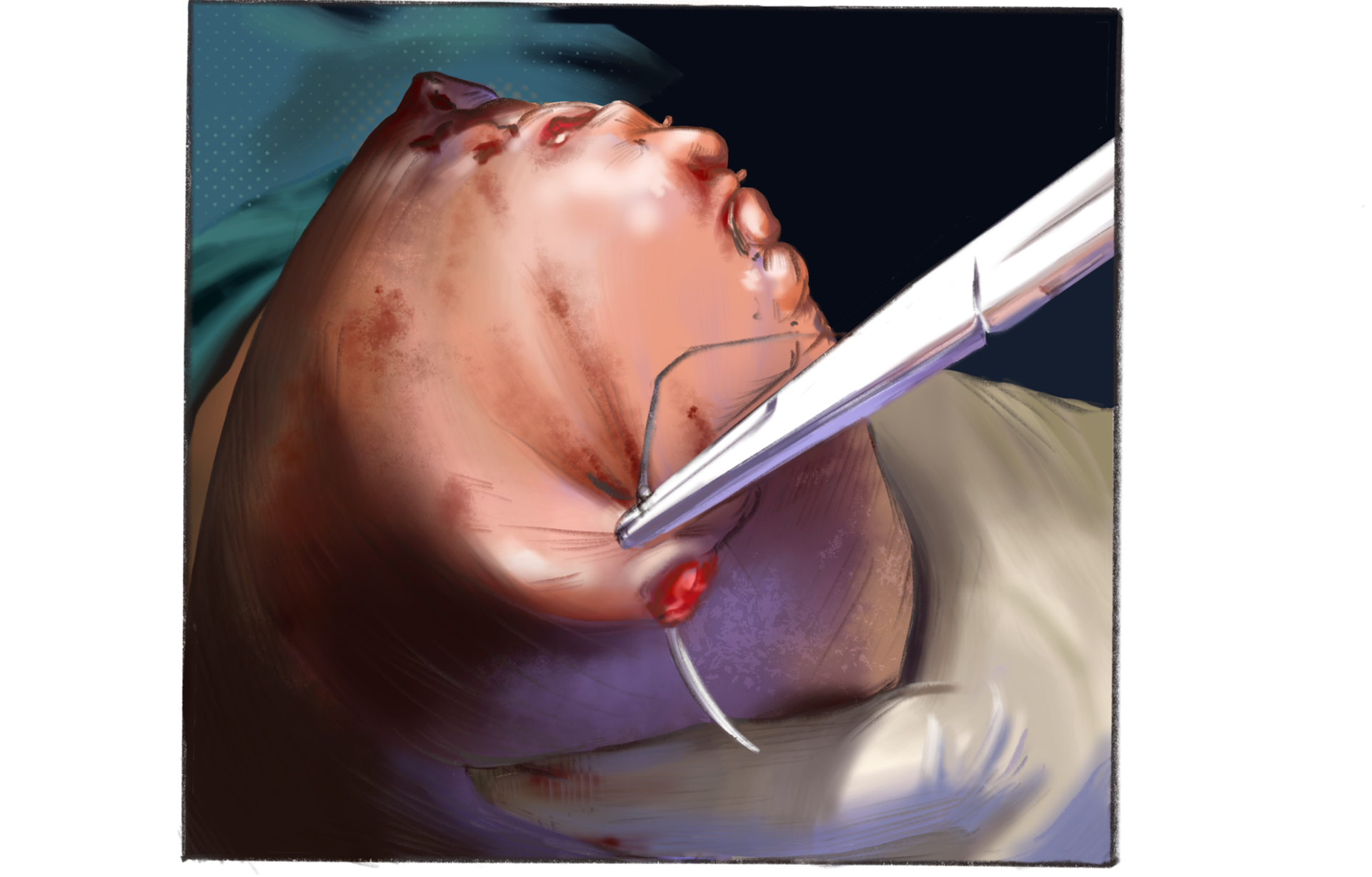 Surgical Observation Study - Procreate - 2021