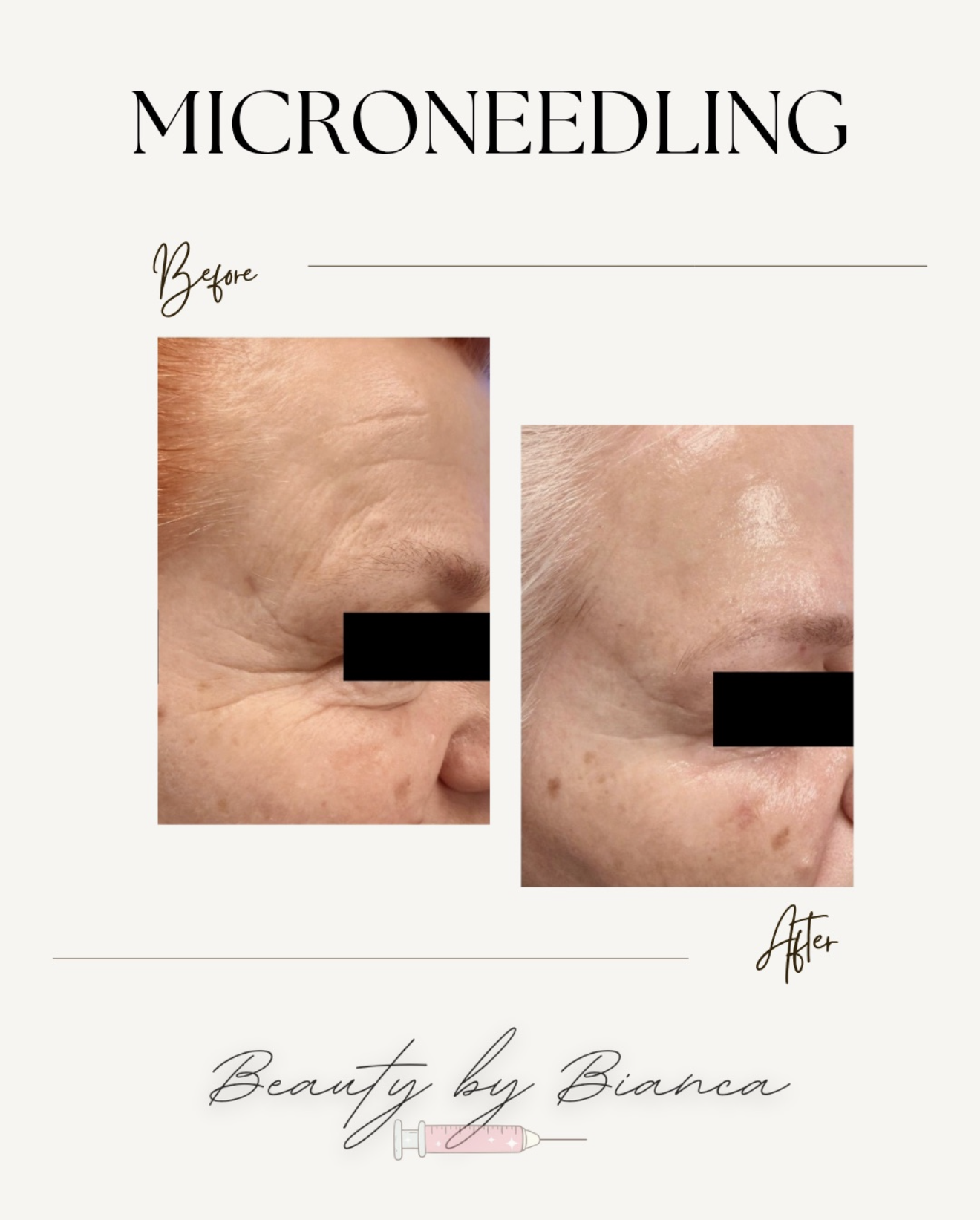 Before and after images showing reduced wrinkles and improved skin texture after a microneedling treatment, with the words "Microneedling" at the top and "Beauty by Bianca" at the bottom.