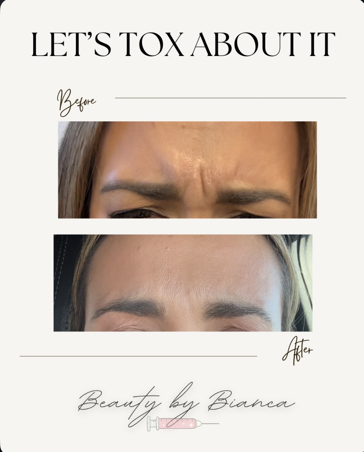 Before and after photos of a woman's forehead showing reduced wrinkles and smoother skin after a cosmetic treatment.
