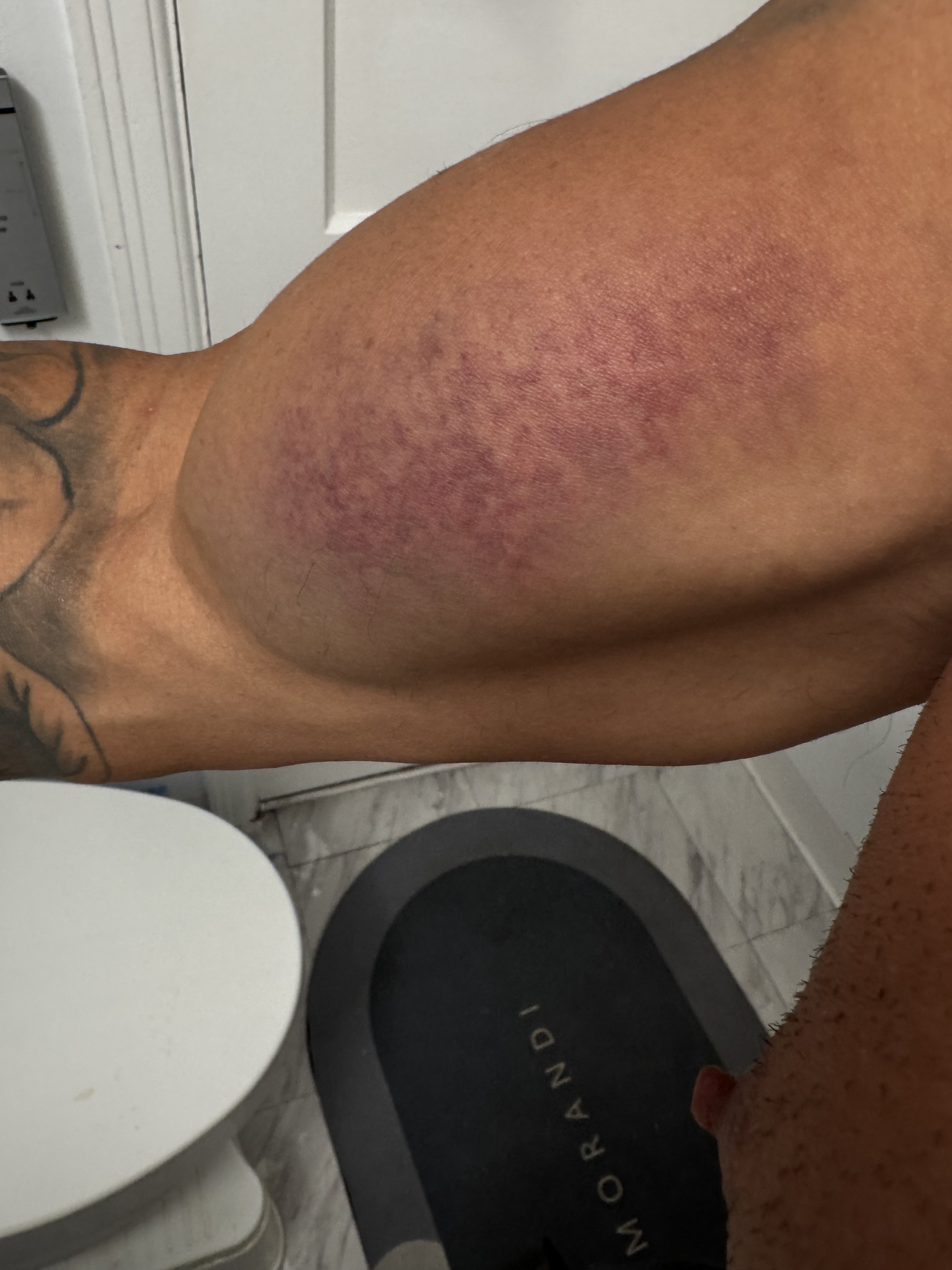 bruising the next day