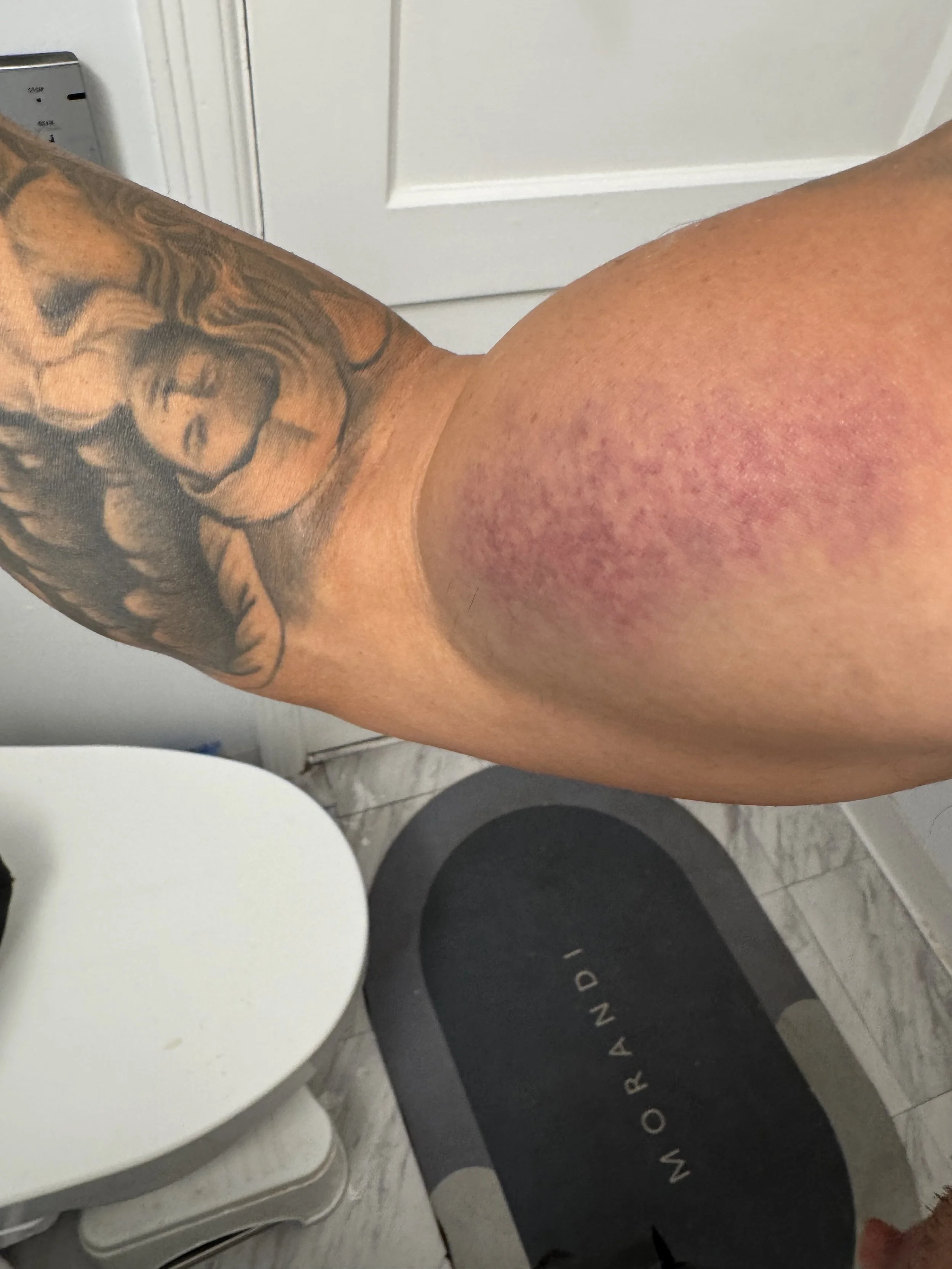 more bruising