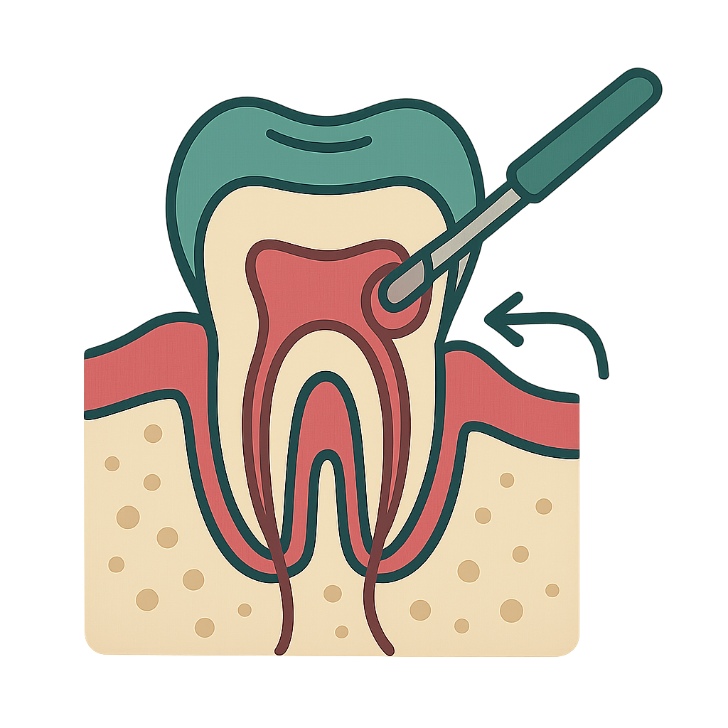 Tooth perforation repair for decay
