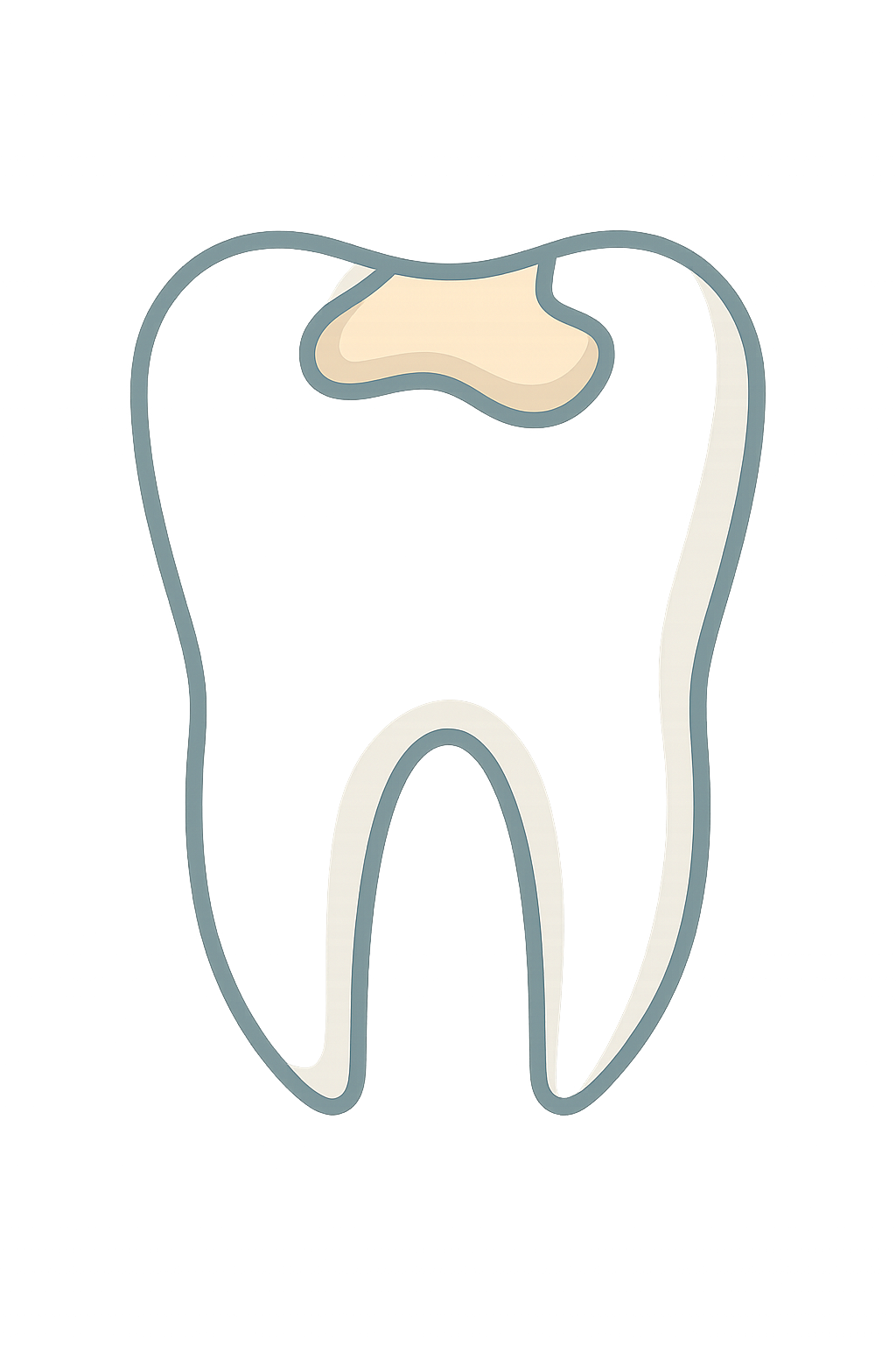 Tooth Colored Mercury Free Fillings
