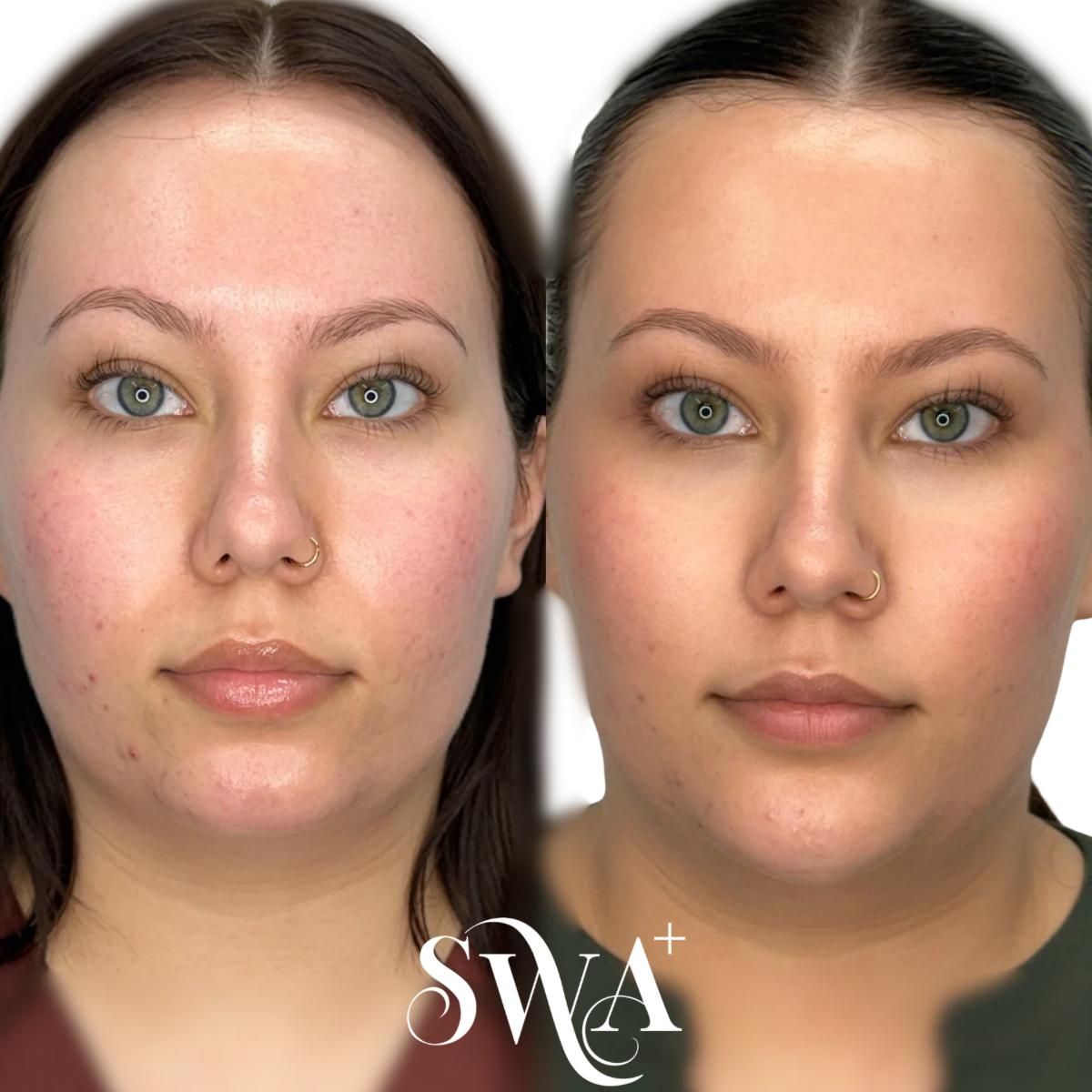 Chin Filler