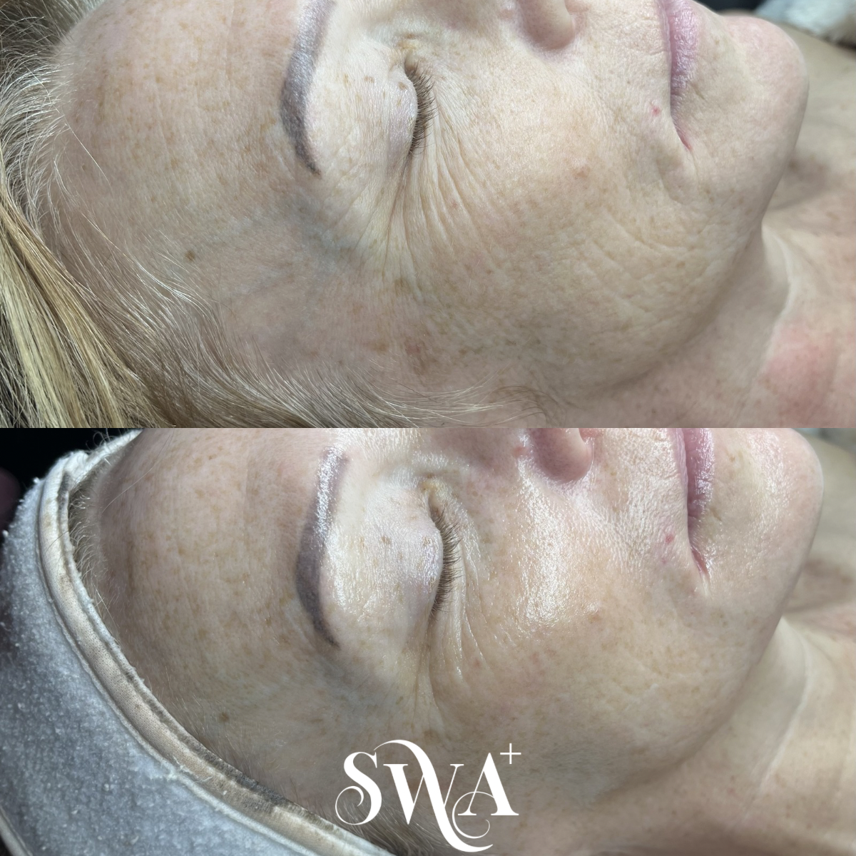 100x Glo2 Facial