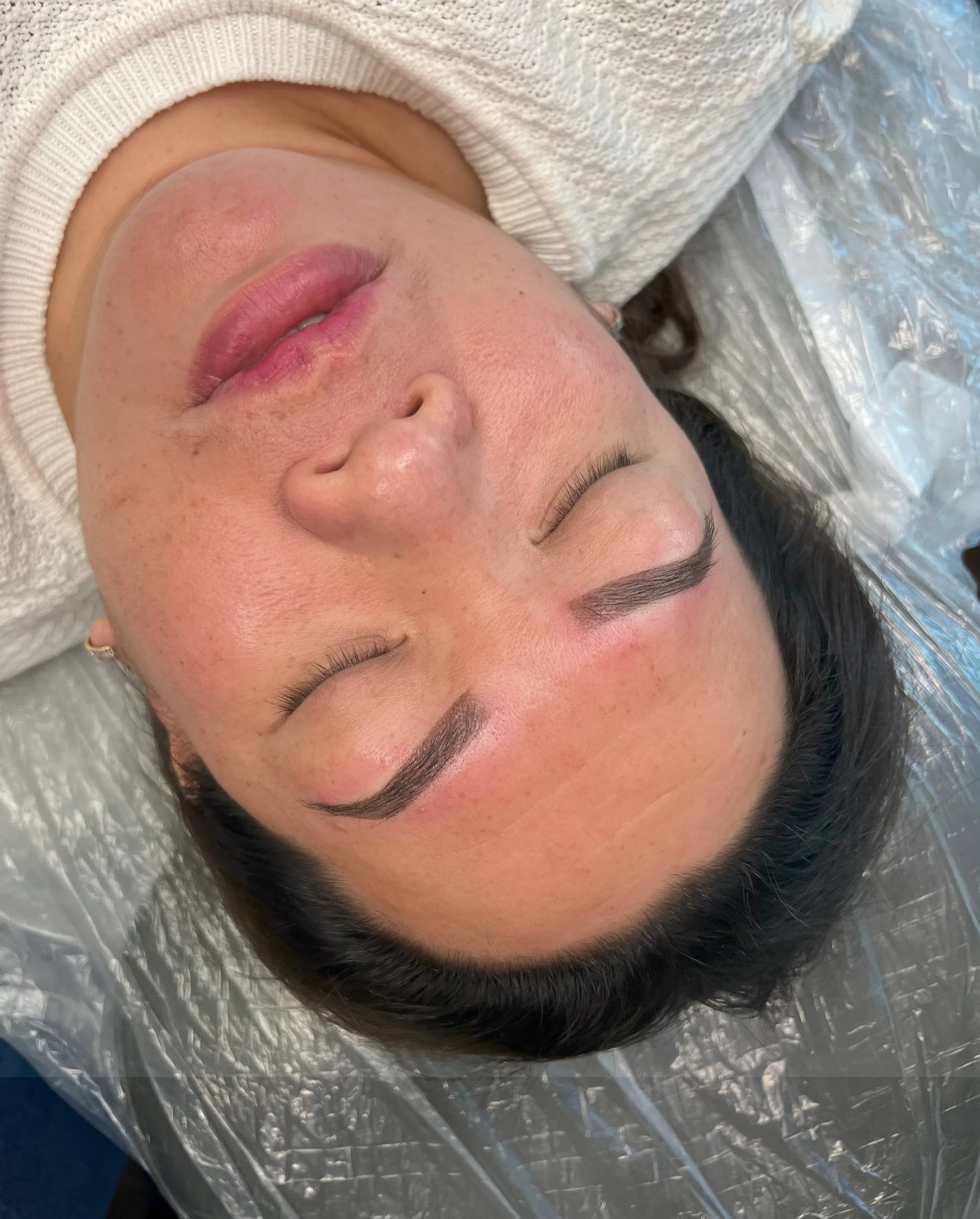 Close-up of a woman with dark hair and fair skin lying on a surface covered with a reflective, silver-colored material. She is wearing a white knit top and appears to have just undergone a cosmetic procedure, with some redness on her cheeks and lips.