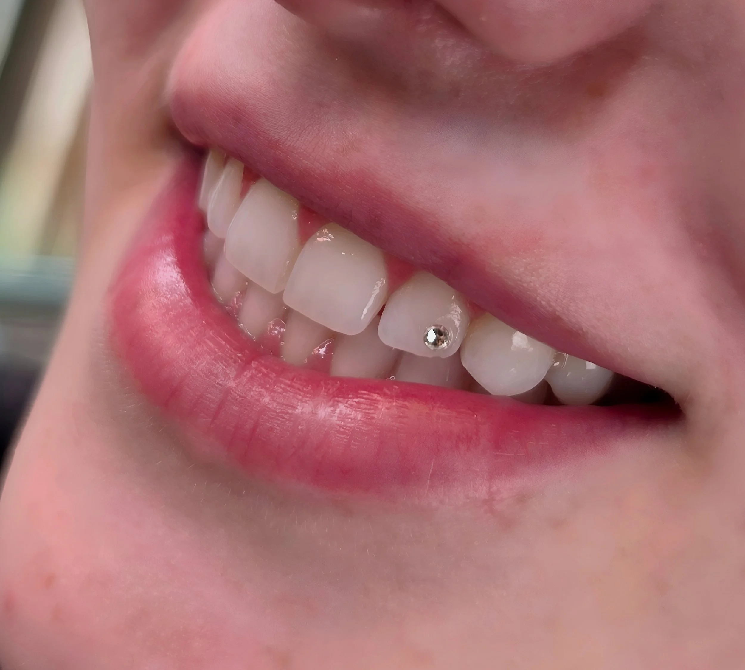 Close-up of a person's lower face and mouth, showing teeth with braces on the top front teeth. The person's lips are slightly parted.