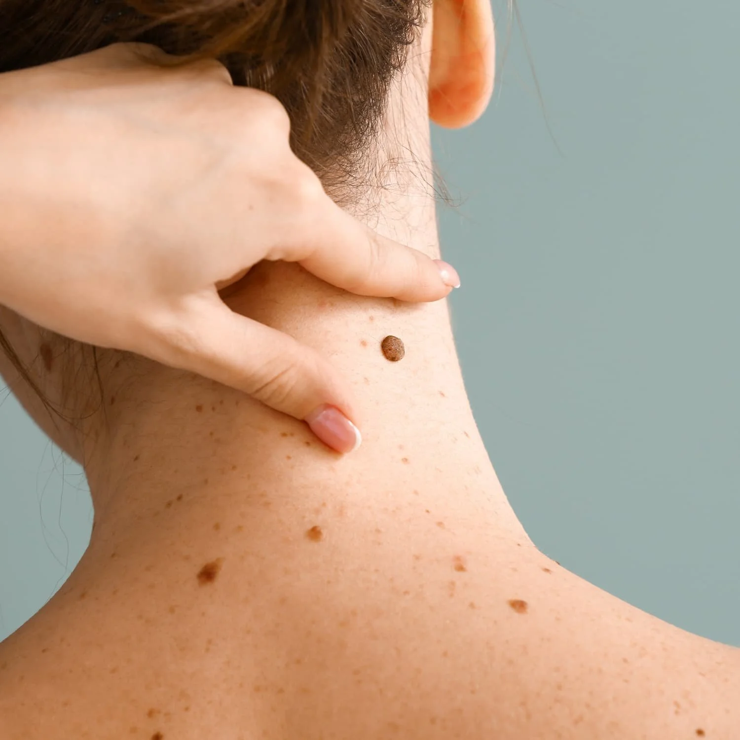 A person's neck and shoulder with freckles and moles, with a hand touching a mole on the upper back near the shoulder, and hair partially covering the face.