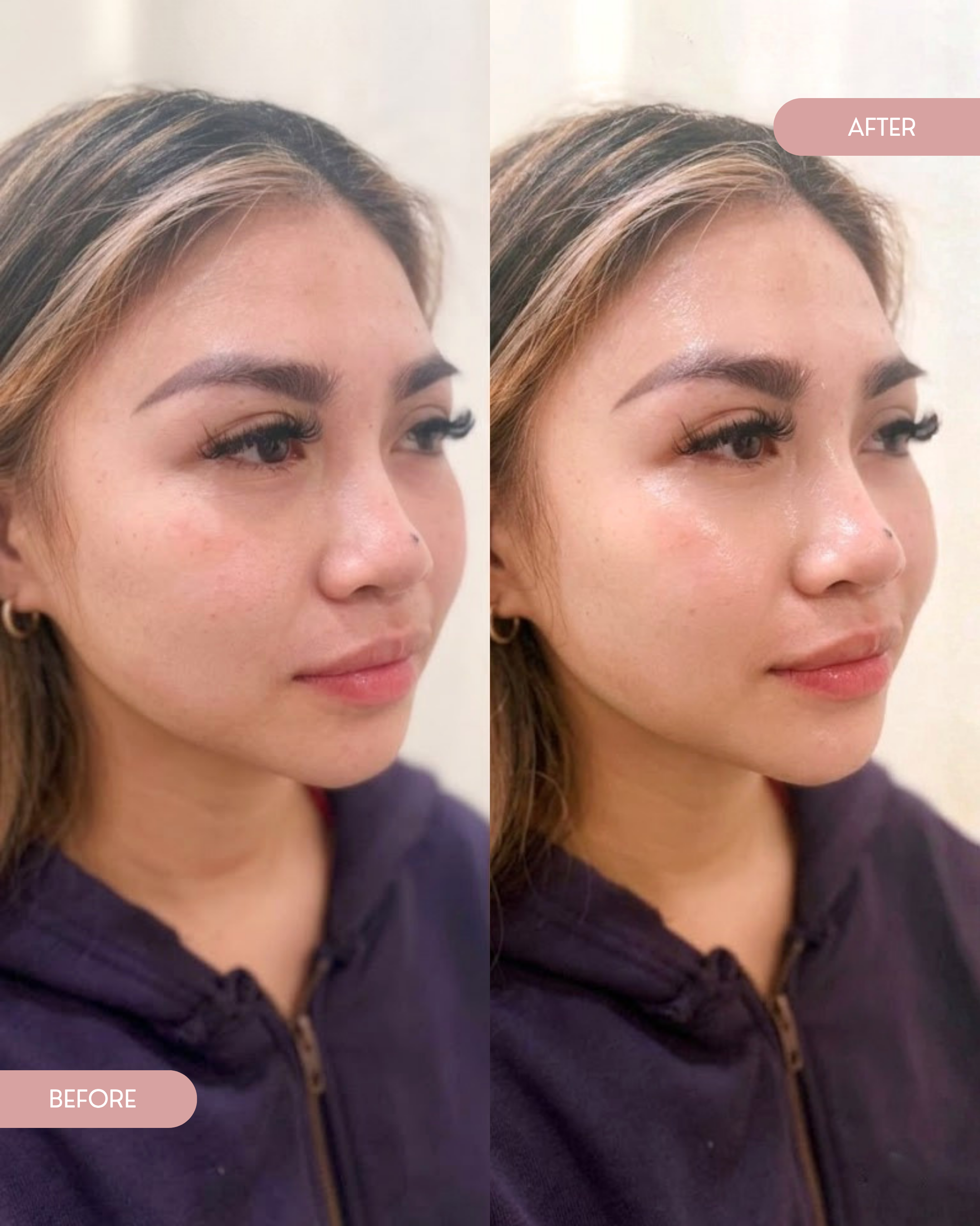Comparison of a woman's face showing before and after cosmetic treatment, focusing on forehead and eyebrow area, with her wearing a dark hoodie.