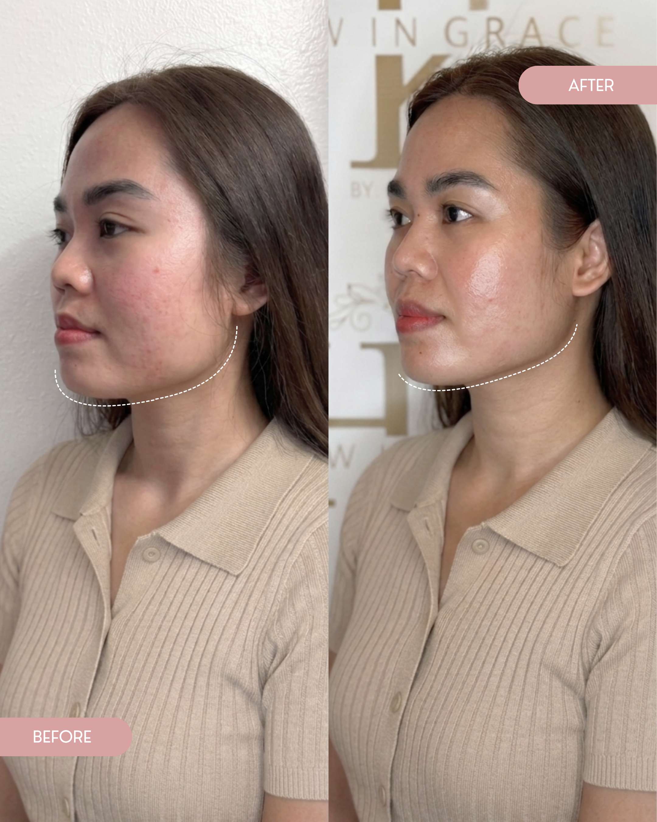 Comparison of a woman with acne-prone skin before and after skincare treatment, showing clearer skin in the after image.
