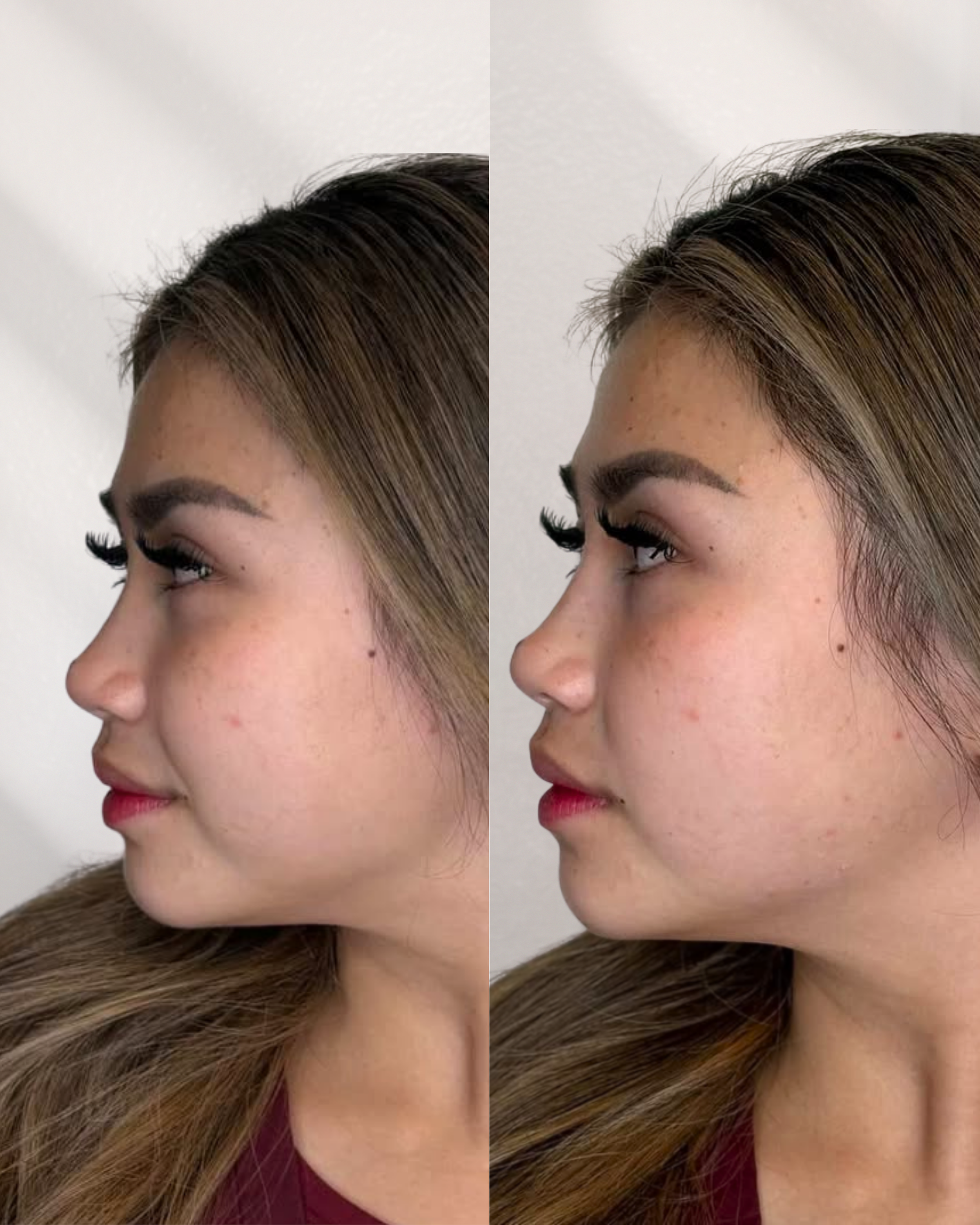 Side-profile before-and-after comparison of a client's jawline and facial contour at Glow in Grace Aesthetics in Carson, CA.