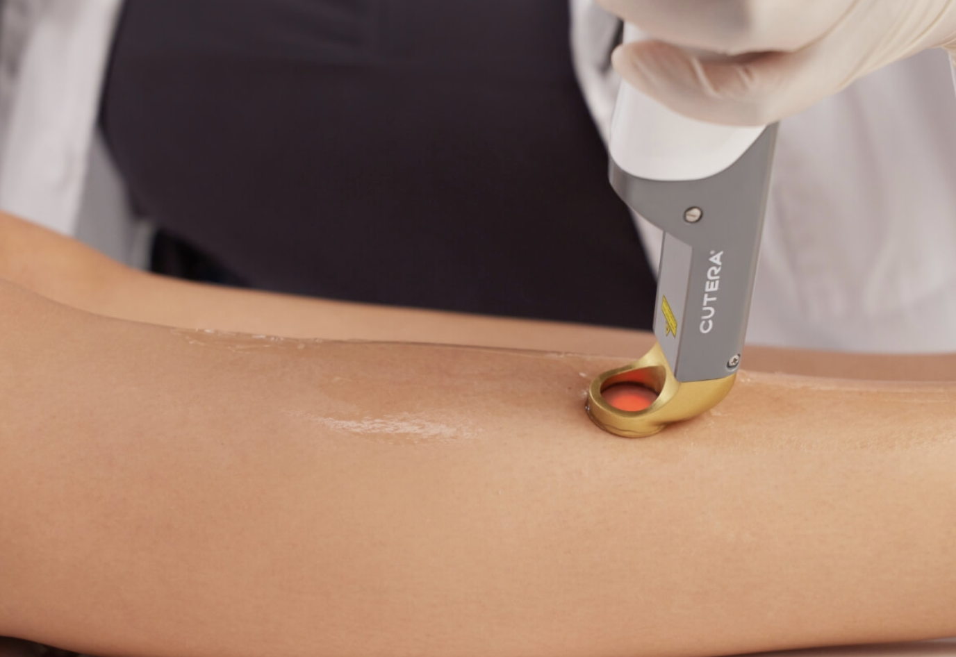 The cutera hair removal laser in action on a leg.