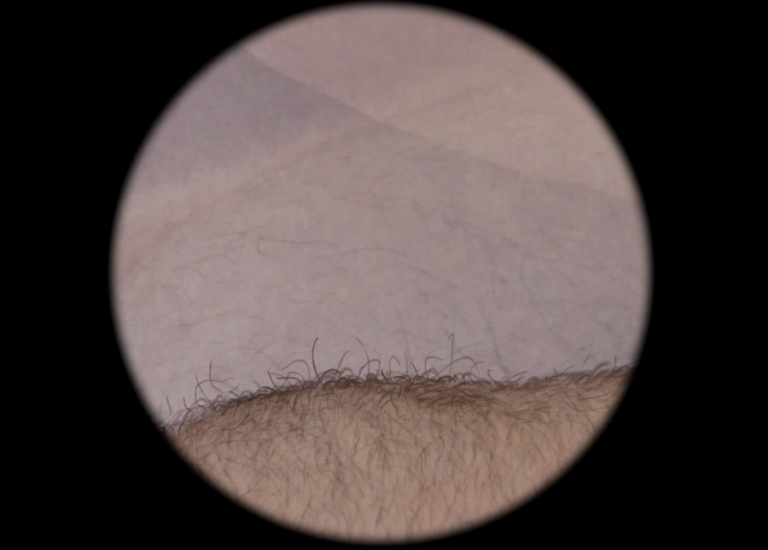 Close-up view of a human hairy body part, possibly skin, through a circular magnification
