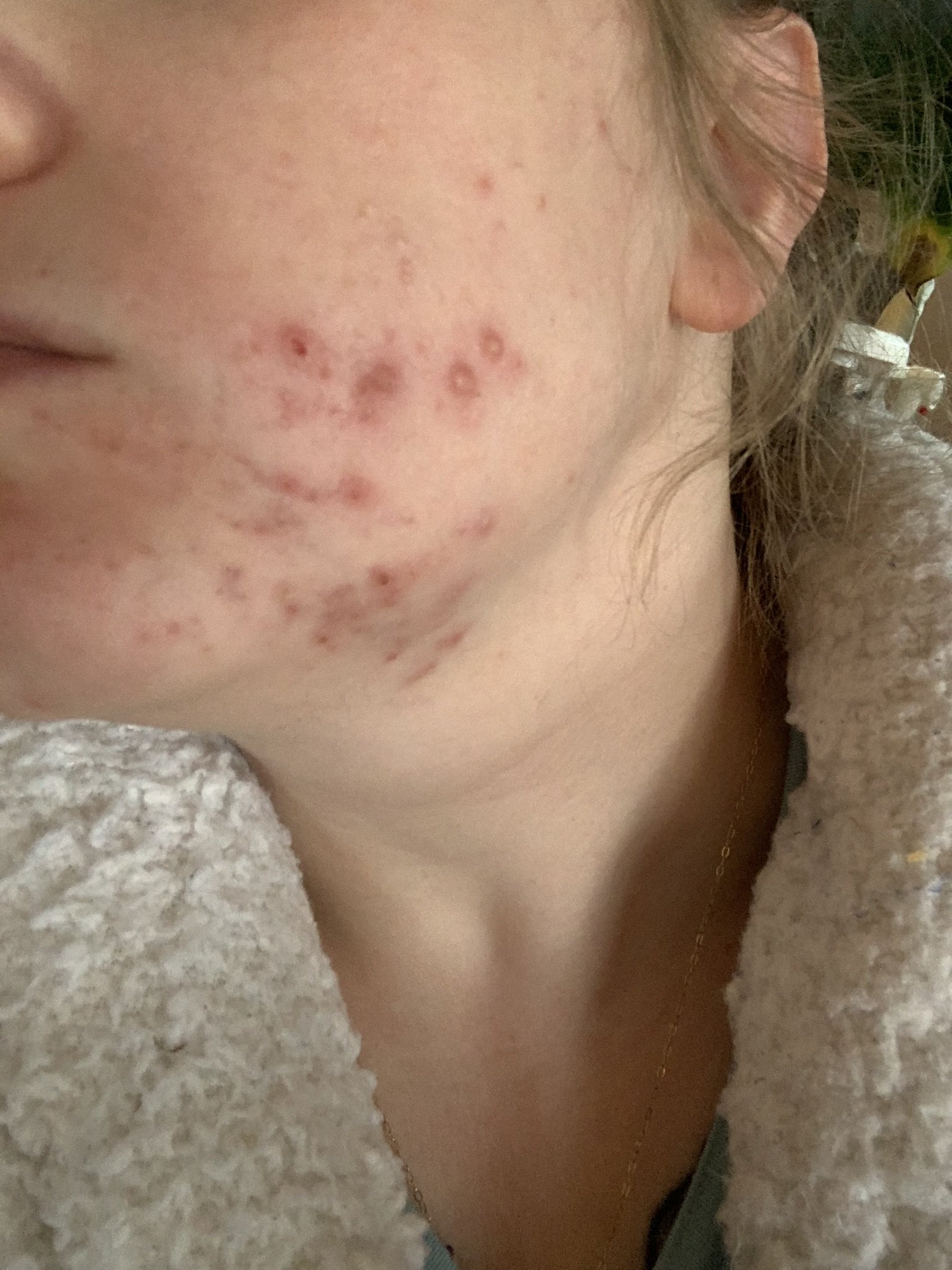 Close-up of a person's face with acne and skin blemishes, showing part of the ear, cheek, and neck, with a textured surface and a beige clothing collar.