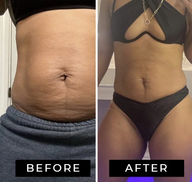 Comparison photo showing a woman's abdominal area before and after of ultrasound fat cavitation. The left side shows a fat belly with loose skin, while the right side shows a firmer, toned abdomen and waistline in a black bikini.