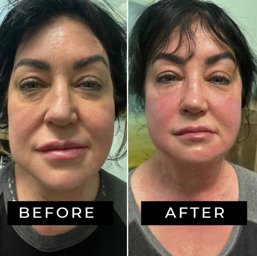 Side-by-side comparison of a woman before an ultrasonic sculpting session. In the 'before' photo, her face is asymmetrical, saggy, and her nose is crooked, while in the 'after' photo, her face is lifted, symmetrical and her nose is straight.