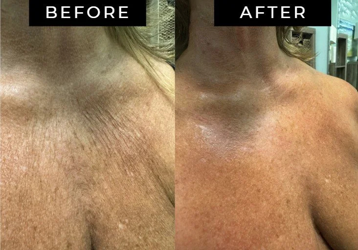 Before and After comparison of a woman's neckline and chest area with crepey skin, showing visibly improved skin texture and younger looking tighter skin in the after photo compared to the before photo.