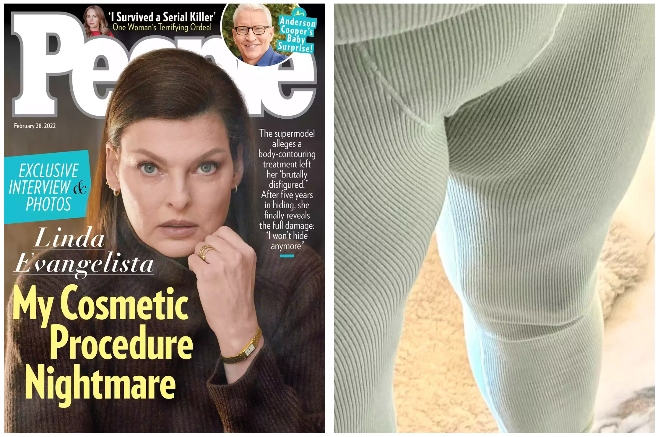 Why Thousands of CoolSculpting Clients Are Looking for Alternatives