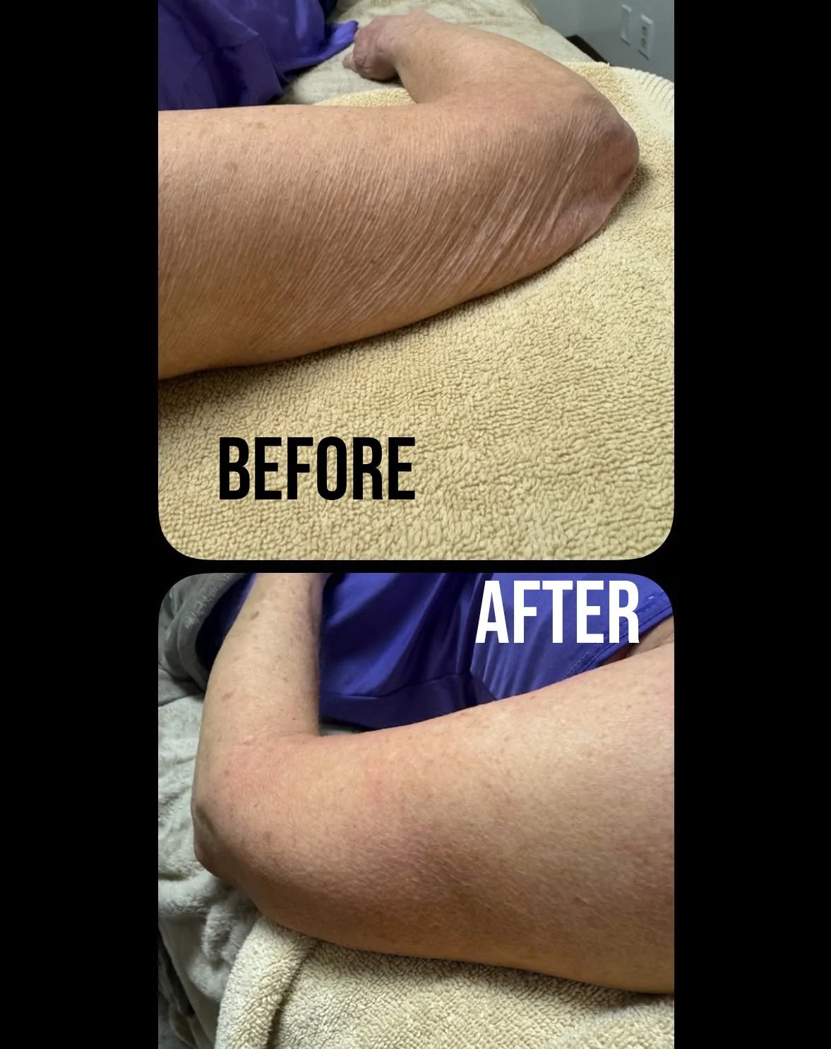Before and after results of ultrasonic body sculpting on a client's upper arm showing tightened, smoother skin after Fat Welding treatment