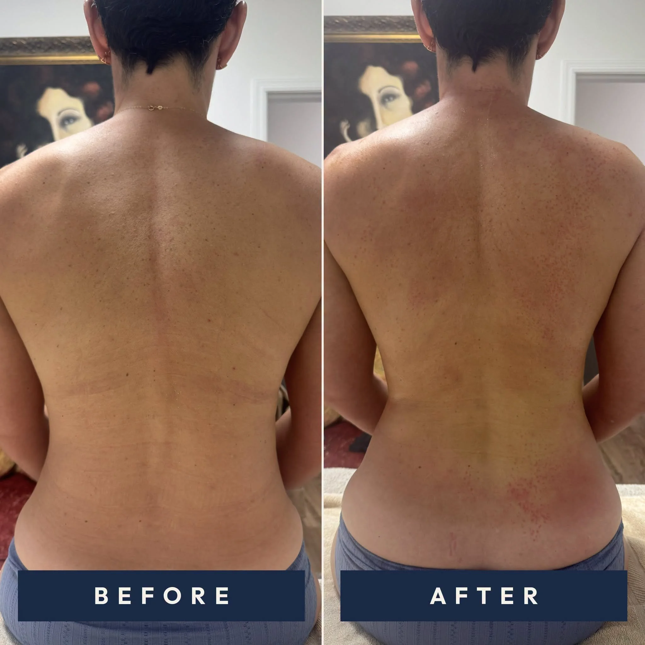 Side-by-side before and after photos of a woman’s hourglass waist and flanks from a body contouring session using the SONARA and the Fat Welding™ technique.
