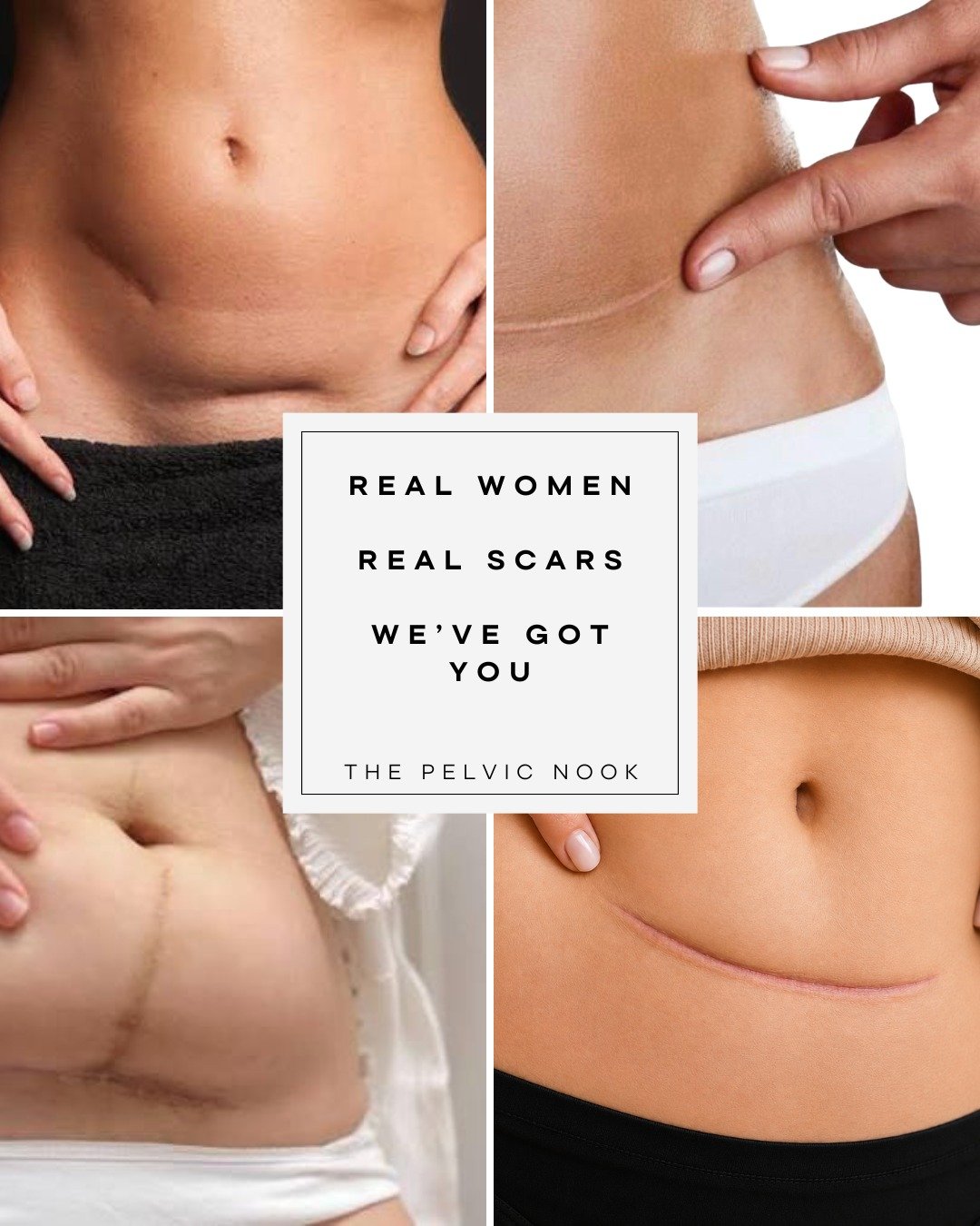 ✨ A C-section shelf is common&mdash;but you don't have to navigate recovery alone.

Pelvic floor therapy can help improve scar mobility, restore core function, reduce discomfort, and support your postpartum healing journey.

Healing isn't about &quot