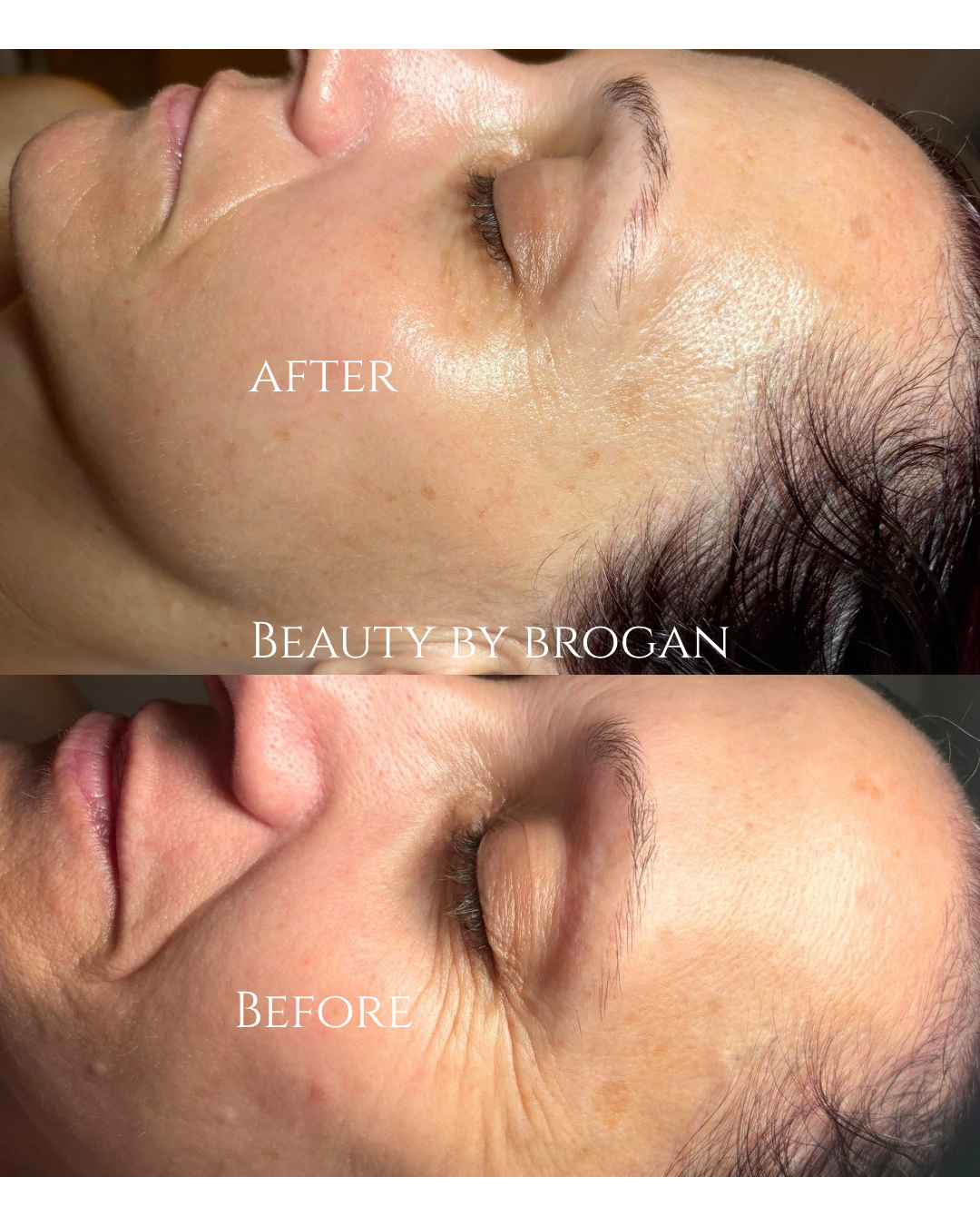 VTOX + Dermaplane